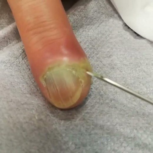 [閲覧注意] 指先が腫れて痛い 化膿性爪囲炎