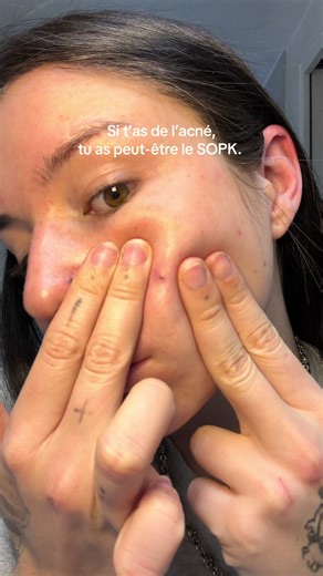Lutter contre l'acné hormonale avec Circles