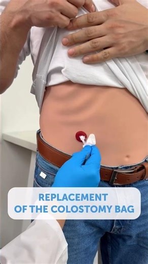 Replacement of Colostomy Bag | Stoma Care Nursing Procedure Explained #shortvideo