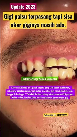 INSTALLING FALSE TEETH WITHOUT REMOVING THE REMAINING TOOTH ROOTS #falseteeth #remainingtoothroot...