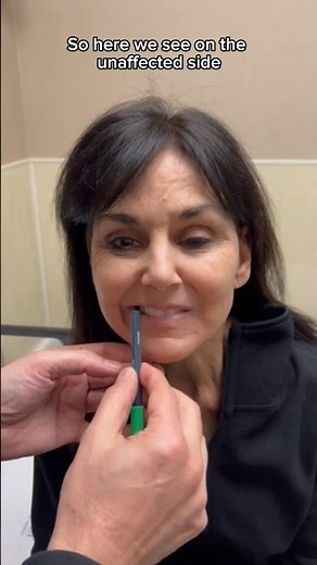 Unilateral synkinesis surgery pre-op #facialparalysis #drazizzadeh