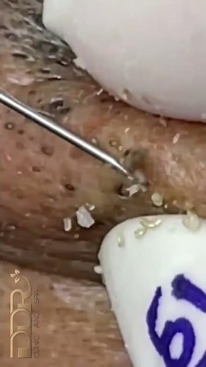 Big Cystic Acne Blackheads Extraction Blackheads & Milia, Whiteheads Removal Pimple Popping #Shorts