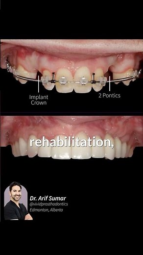 What is a Prosthodontist? | Dental Implant & Cosmetic Dentistry Specialist
