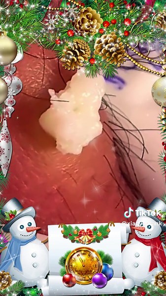 #pimple #acne#pimples #pimplepop #satisfyingvideo #pimplepop #fyp