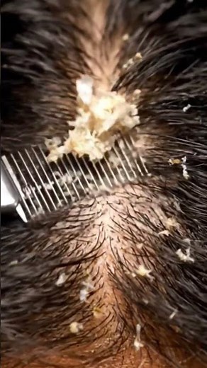 Warning: You May Fall Asleep | ASMR Macro Scalp Scratching & Dandruff Removal