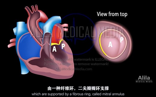 【Alila Medical Media】13.二尖瓣脱垂和返流