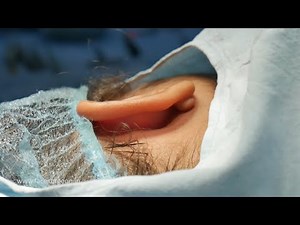 Dr. Richardson Removes Keloid From Woman's Ear