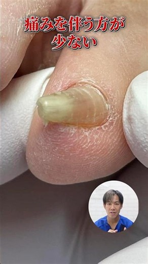 日常生活に支障をきたす小指の巻き爪！初回施術で大きく改善しました