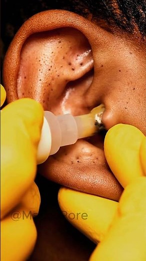 Extreme Comedone Removal on Ear 👂 | Macro Skincare ASMR