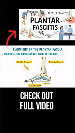 Understanding Plantar Fasciitis