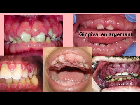 gingival enlargement