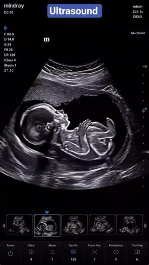 ultrasound scan for fetal growth 💹📈