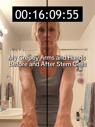 I applied this plant stem cell body treatment to just ONE arm, and this unretouched 19-minute time-lapse speaks for itself. 🤯⏱️ Ready for a real body glow-up? This plant-based smart-serum creates an invisible, breathable firming matrix that visibly smooths and tightens the look of crepey, thinning skin in real-time. 🌱 No harsh actives or sticky lotions—just potent plant stem cells delivering powerful botanical nutrients directly to your skin for a visibly thicker, plumper, and more resilient a