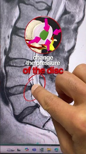 L4-L5 Disc Herniation: Leg Numbness Relief with Decompression | Real Patient Story