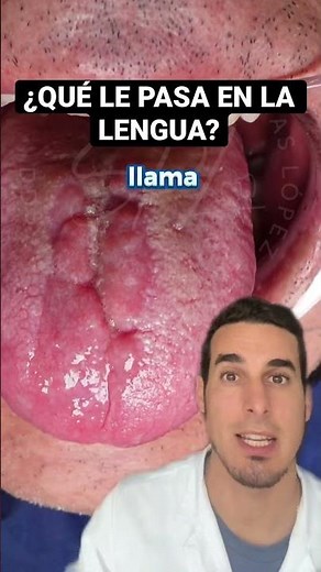 ¿Qué le ocurre en la LENGUA? GLOSITIS ROMBOIDAL - Papilas gustativas