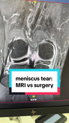 This is a medial meniscus tear. Here's how it looks on MRI, and the same tear at arthroscopy. Follow for more like this- complex knee problems, made simple. #meniscus #meniscustear #knee #kneeinjury #orthopaedics