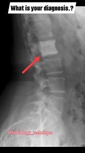 X ray L. S. Lat showing L1 different vertibrea.. What is your diagnosis..? . . . . . #radiology_technique #viralreels #reelsinstagram #radiographer #radiology #xray #medicalstudent #reels #radiologist #lumber #radiologia | Diwakar Patel