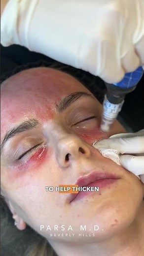 Microneedling with PRF Vampire Facial for Skin Rejuvenation