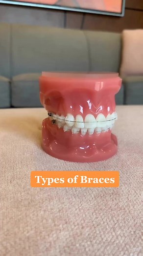 Exploring Different Types of Braces for Teens
