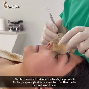 Nose Cast Removal after Rhinoplasty Surgery