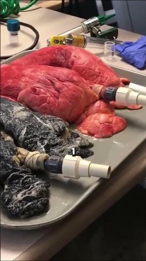 What happens to your lungs after 20 years of smoking?