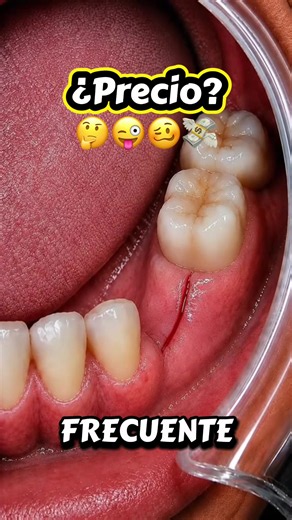 #paratiiiiiiiiiiiiiiiiiiiiiiiiiiiiiii #fypシ゚viral #odontologia #protesisdental #xyzbca