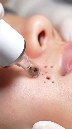Professional pore-cleaning session using a vacuum extractor #skincare #asrm #macro
