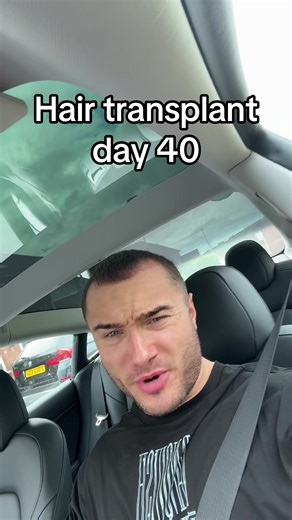 My Hair Transplant Journey at 40 Days Post-Procedure