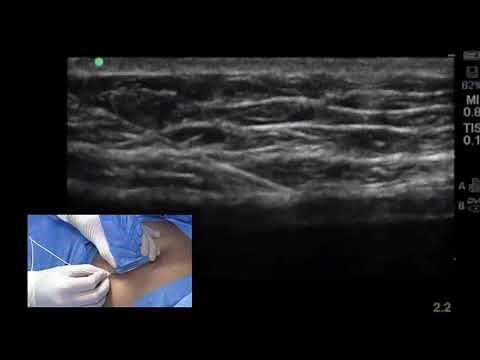 The Ultrasound-Guided Rectus Sheath Block (RSB)