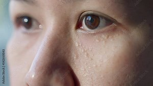 Syringoma milia milium cysts or seborrheic keratosis on asia people female face body care. Close-up young adult asian woman under eye small acne liver spot skin issue smile with pride look at camera.