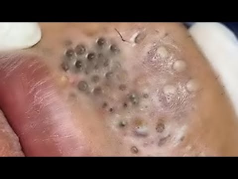 𝑹𝒆𝒎𝒐𝒗𝒊𝒏𝒈 𝑯𝒊𝒅𝒅𝒆𝒏 𝑫𝒊𝒓𝒕 𝑭𝒓𝒐𝒎 𝑷𝒐𝒓𝒆𝒔 | 𝑺𝒐𝒐𝒕𝒉𝒊𝒏𝒈 & 𝑺𝒂𝒕𝒊𝒔𝒇𝒚𝒊𝒏𝒈 #866322