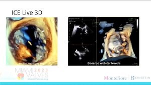 Integrating ICE in Transcatheter Tricuspid Intervention