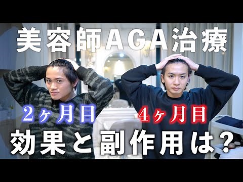 薄毛美容師がAGA治療を初めて2~4ヶ月の経過報告!! 効果や副作用について