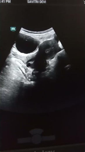 Nabothian cyst/Cervical Cyst#ultrasound scanning#viral song#shorts#video#please#subscribe