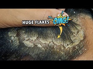 Removing Dandruff From Scalp Satisfying #613