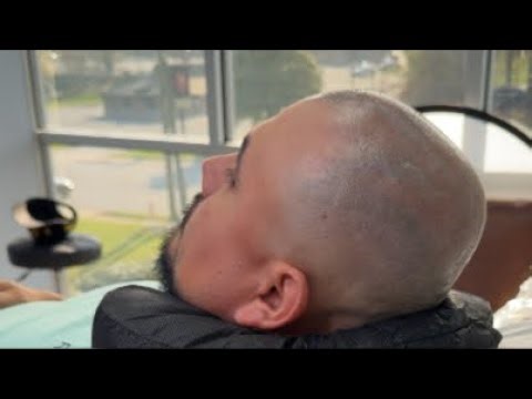 SMP 2nd Session Transformation LIVE | Scalp Micro Pro Clinic