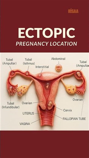 Ectopic Pregnancy Locations 🩸