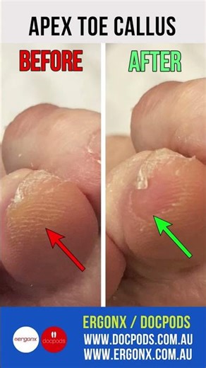 Satisfying Callus Removal by Podiatrist Using Scalpel Foot Care Expertise ASMR