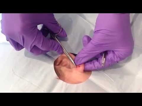 Cyst Excision : Surgical excision of a cyst on the earlobe