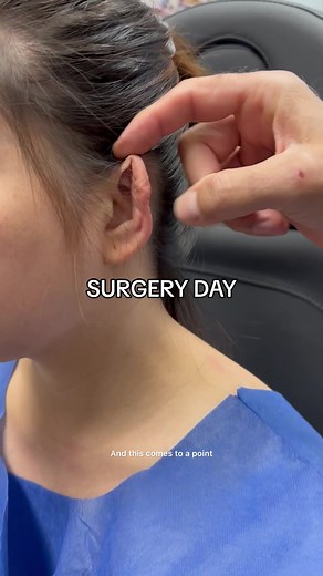 Infection from an ear piercing 👂🏼Who wants to see the results? #infection #earinfection #surgery #pinnedbackears #beforeandafter #surgeryrecovery