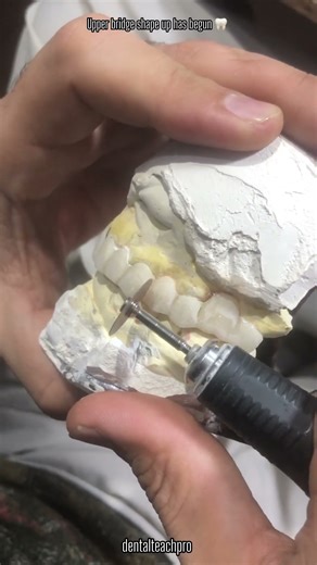 Upper bridge shape up has begun 🦷 #shorts #trending #dentallab #youtubeshorts #viral #ytshorts