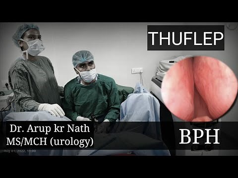 ThuFlep || Thulium Fibre laser Enucleation of Prostate || 59 gm in 35 min ll Arup kumar nath @ AUKD