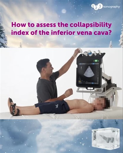 123sonography | How to assess the collapsibility index of the inferior vena cava? 👀❄️ Dr. Yogen Singh is demonstrating how this is done – keep on watching!... | Instagram