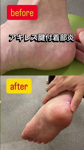 #アキレス腱付着部炎 #踵骨下滑液包炎 #かかとの痛み #鍼灸