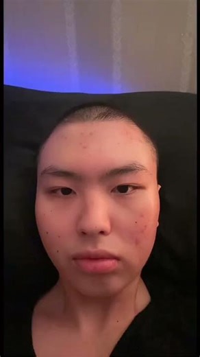 👨‍🦲 and proud #cancer #leukemia #hairstyles