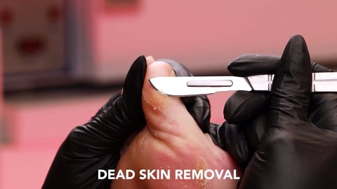 Feet Pampering: Callus Removal & Nail Fixing