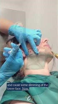 Masseter Botox for Jaw Pain, TMJ & Facial Slimming 👀 | Patient Experience
