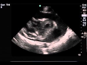 Cardiac Tamponade Ultrasound