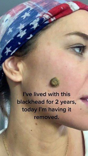 Dr. Pimple Popper Extraction: Removing a Long-Lived Blackhead