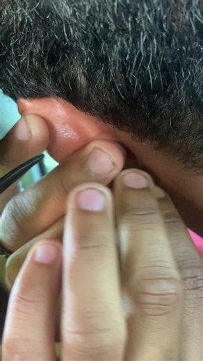 Rryder (@rryder4_)’s video of ear crust removal earring